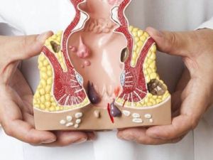 افضل دكاترة بواسير في الرياض