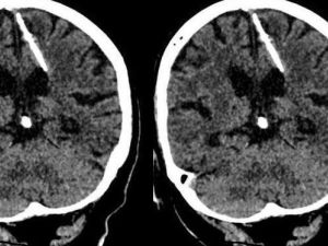 اكتشاف إبرة طولها 3 سم موجودة في دماغ امرأة روسية منذ 80 عاماً