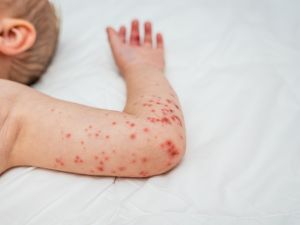 متلازمة اليد والقدم والفم: الأعراض، العلاج