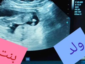 كيف أعرف نوع الجنين في الشهر الثالث بدون سونار