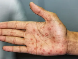 مرض الزهري: مراحله،مضاعفاته، تشخيصه، علاجه