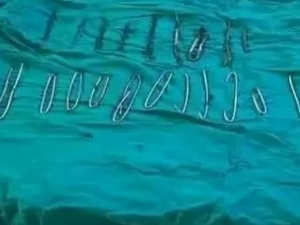 إخراج 20 مسمارًا وأسلاكًا معدنية من بطن مريض في الجزائر