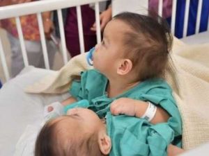  بدء عملية فصل التوأم السيامي أكيزا وعائشة في السعودية