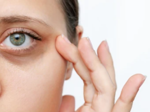 dark circles