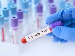 طبيب البوابة: 5 علاجات فعّالة لخفض مستويات حمض البوليك