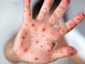جدري القردة هو مرض نادر تسببه عدوى فيروسية