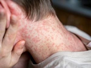 measles outbreak