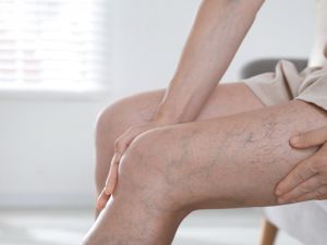 وصفات طبيعية لعلاج دوالي الساقين
