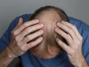 ودّع تساقط الشعر.. أطعمة طبيعية تمنح الرجال شعرًا أقوى
