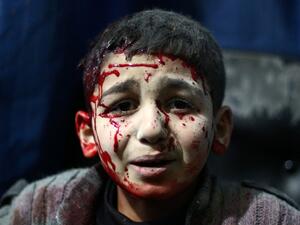 A file photo taken on February 02, 2015 shows an injured Syrian child waits for treatment at a makeshift hospital in the rebel held area of Douma, north east of the capital Damascus, following reported air strikes by forces loyal to President Bashar al-Assad. (AFP/Abd Doumany)