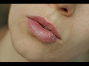 الاسمرار ما حول الفم له العديد من الحلول التجميلية 