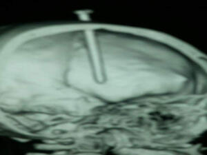 صورة بالاشعة للمسمار في الرأس