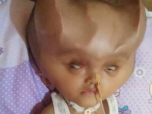 Clyne Solano, 22 months old, has a condition called hydranencephaly which has stopped his brain from developing properly but left him with an enlarged skull containing a lot of fluid (dailymai)