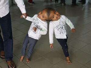 The three-year-old twins will return to Bangladesh after three month to undergo the final operation to separate them (AFP)