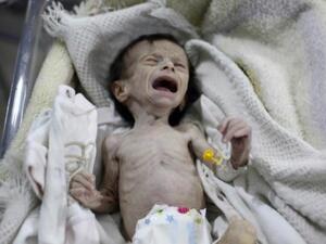 طفل سوري يعاني من سوء تغذية شديد في عيادة في بلدة حمورية في الغوطة الشرقةي المحاصرة قرب دمشق

