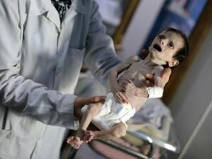 طفلة سورية تعاني سوء التغذية في بلدة حمورية في الغوطة الشرقية المحاصرة
