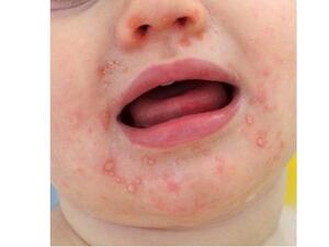 تتضمن أعراض مرض اليد والقدم والفم الإصابة بحمى خفيفة (ارتفاع درجة الحرارة) وضعف عام بالجسم، وظهور قروح بالفم وبقع حمراء وبثور صغيرة على اليدين والقدمين.