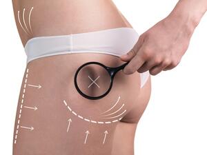 هل ينجح الكونتور في تجميل المؤخرة بشكل دائم؟