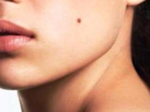 صورة تعبيرية لشامة الوجه