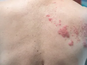 مرض الحزام الناري هو نفس فيروس جدري الماء