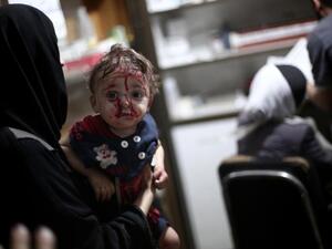 An injured child waits for treatment following reported shelling in Douma (AFP/ File Photo)