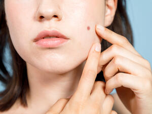 الشامات هي بقع جلديّة غير مؤذية تمتاز بلونها البنّي

