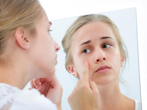 أن تعاني من حب الشباب لا يعني أن تهملي ترطيب بشرتك
