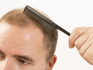تساقط الشعر مشكلة شائعة جداً تؤثّر في الرجال والنساء على السواء