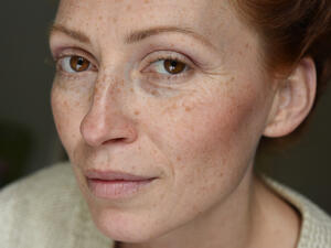 الكلف حالة شائعة تصيب عادة النساء.