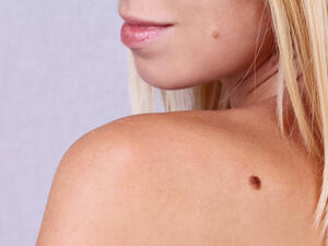 الشامات هيَ أورامٌ على الجلد، وعادةً ما تكونُ بنية أو سوداء اللّون

