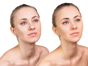 جربي ماسك البرتقال والكركم الرائع للقضاء على مشاكل البشرة