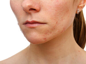 يعمل زيت الزيتون على تخفيف حفر الوجه وتفتيح الحفر الدّاكنة