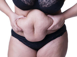 تشققات الجلد المصاحبة للحمل من أكثر الأشياء التي تؤذي نفسية الحامل

