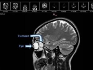The patient was discharged the following day, with her vision fully restored. (File photo)