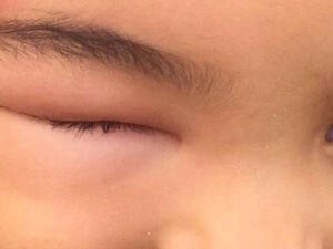 A Saudi child suffering from mosquito bites has his eye swollen shut. (Twitter)