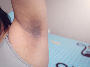 تعتبر منطقة الإبطين بيئة ملائمة لنمو الفطريات التي تسبب إحمرارا في الجلد