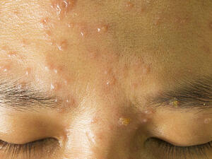 Chicken pox. (Shutterstock)