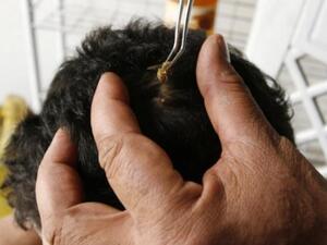 فلسطيني يعالج بواسطة النحل في احدى العيادات الطبية بغزة/الصور لـ أ.ف.ب