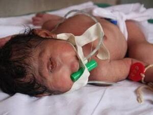 أجهزة الطفل تعمل بشكل طبيعي رغم التشوه