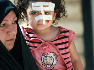 طفلة عراقية جريحة نتيجة احدى التفجيرات