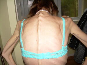 Hot? NOT! Anorexia is growing throughout the world and the Middle East is no exception. 