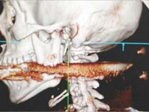 صورة باشعة اكس تظهر الرمج في العنق