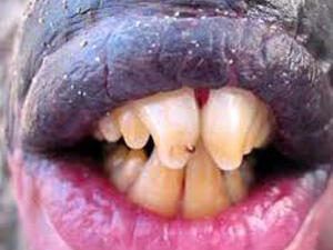 اسنان اللولي