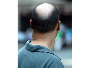 Balding men have something to smile about.