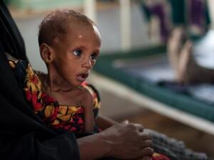 طفل صومالي يعاني من سوء تغذية حاد ينتظر في عيادة اطباء بلا حدود في دداب في كينيا،
