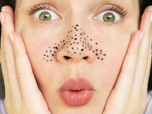 أغلب الفتيات يعانين من مشكلة الرؤوس السوداء  (shutterstock.com)
