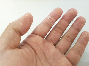 مرض الصدفية (shutterstock.com)
