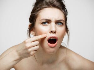 ضعي عصير الليمون على وجهك لبضع دقائق لمحاربة الالتهابات. (shutterstock.com)
