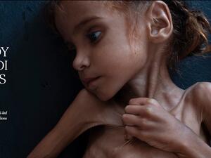 "فيسبوك" يكسر قواعده ويسمح بنشر صورة لطفلة يمنية تتضور جوعا