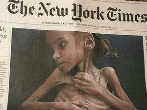 وفاة أمل اليمنية التي أثارت صورتها ضجة عالمية